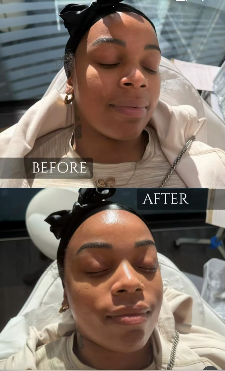 Aesthetics treatment result at Pure Drip Aesthetics Snow Hill Birmingham